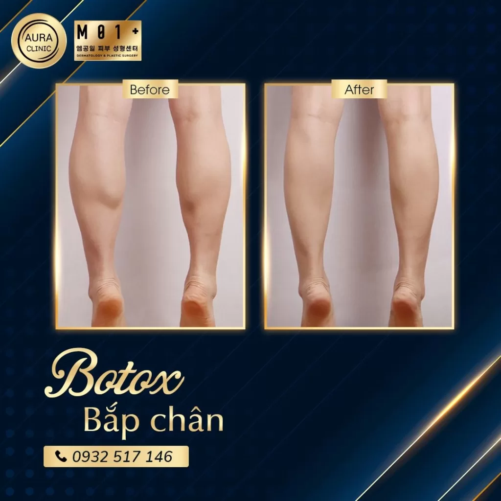 Tiêm Botox body là gì? Vì sao có thể làm thon gọn body?